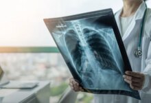 Kronik Tromboembolik Pulmoner Hipertansiyon Hakkında