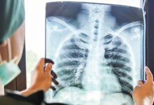 Türkiye’de 3 Milyon Kişi KOAH Hastalığının Farkında Değil