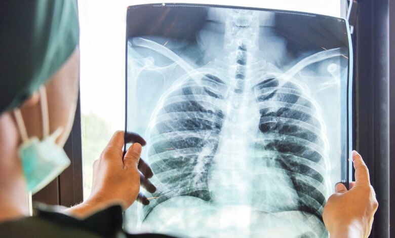 Türkiye’de 3 Milyon Kişi KOAH Hastalığının Farkında Değil